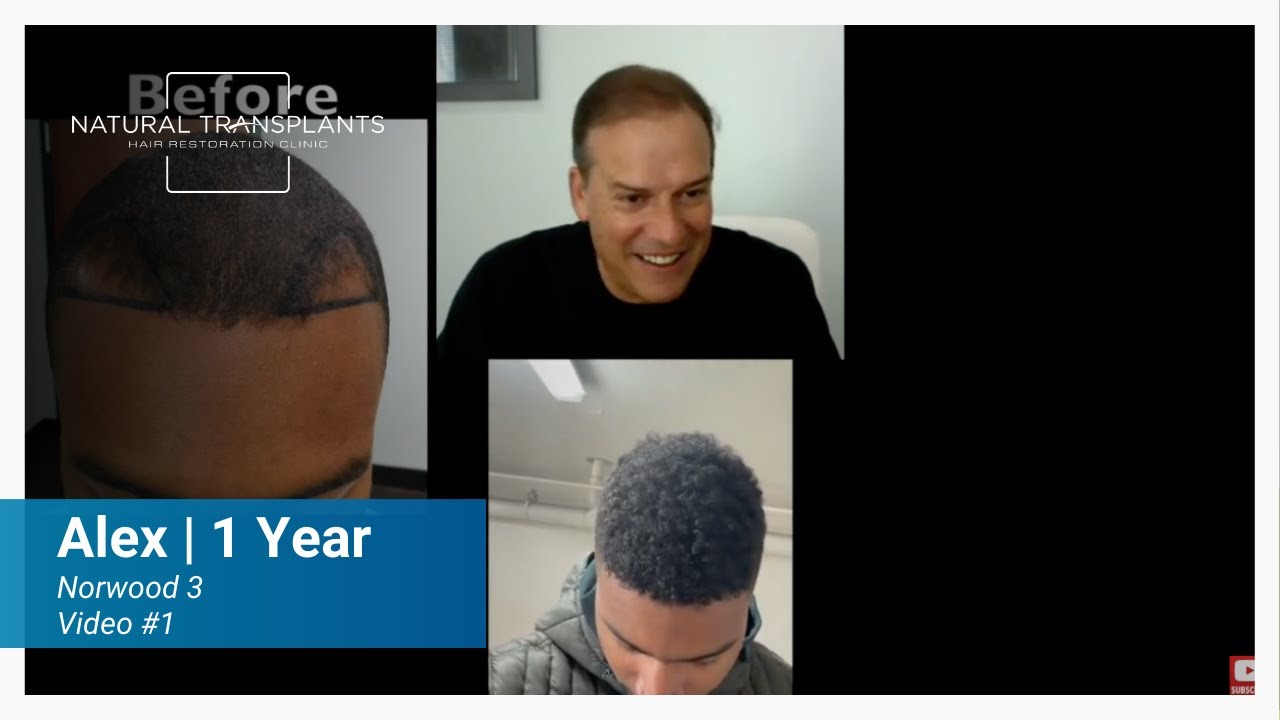 1 Year Hair Transplant Results with 27 Year Old Norwood 3 Patient| Alexander (Dr. Siegel)