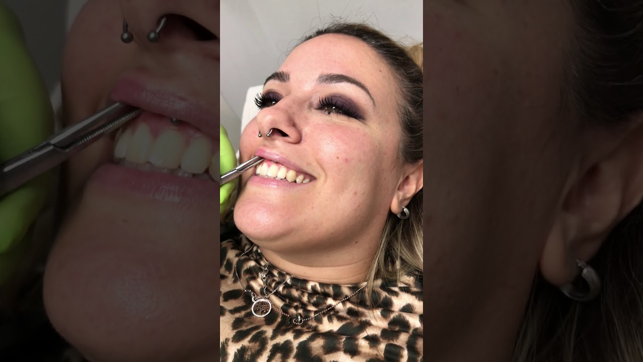 SEPTUM AND SMILEY SUPER FAST AND PAINLESS!