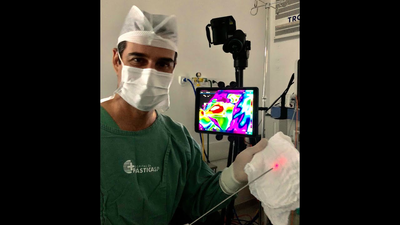 Lipo a Laser com Camera Térmica
