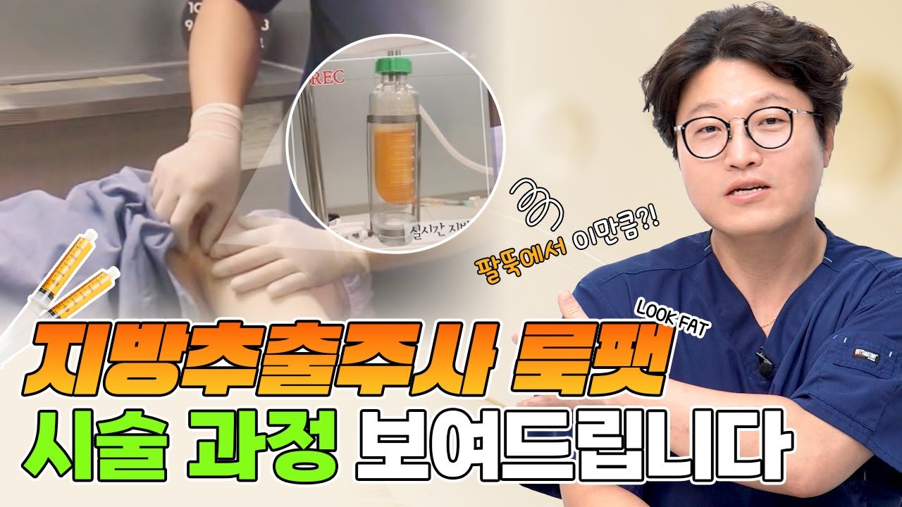 덜렁거리는 팔뚝살, 지방추출주사 맞으면 얼마나 빠질까? (시술 과정, 시술 전후 비교)