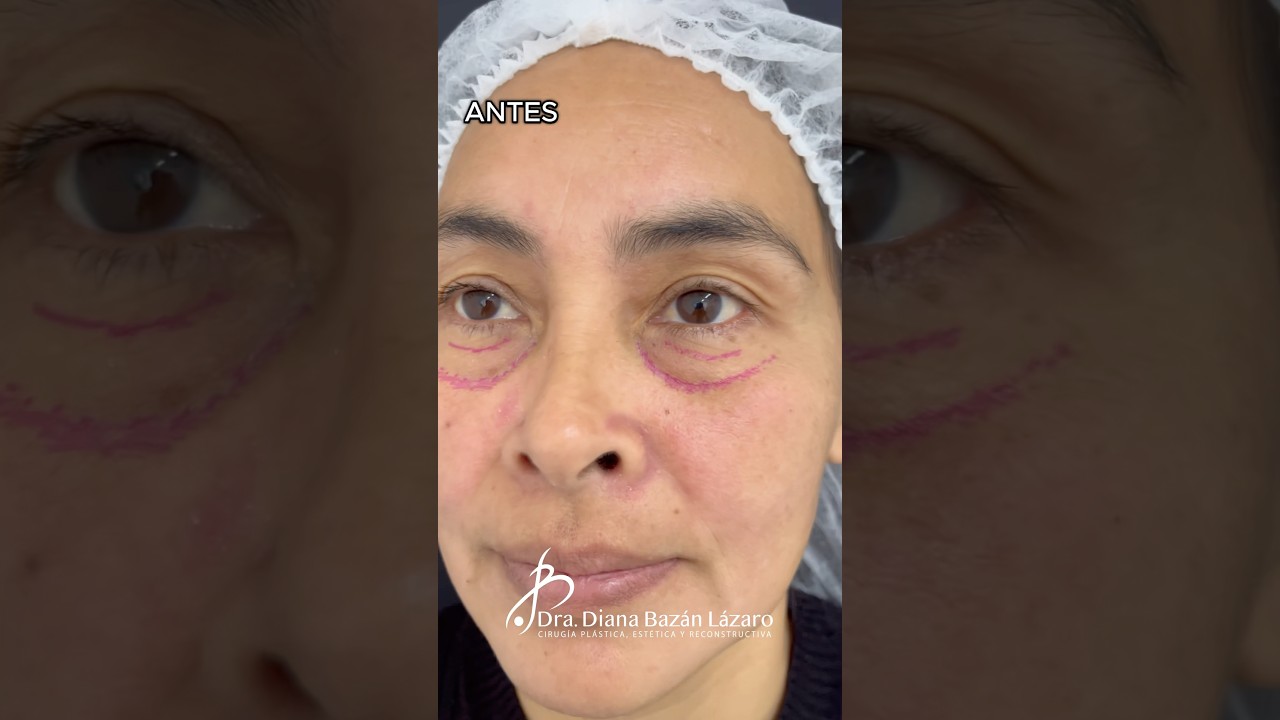 Blefaroplastia inferior ✂️ #blefaroplastia #ojeras #bolsas #mirada #antesydespues #cirugiaplastica