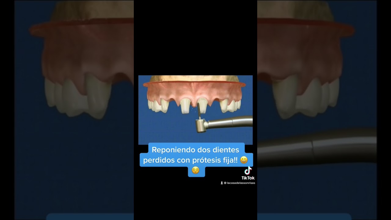 Reponiendo dos dientes perdidos con pr&oacute;tesis fija!! 😃😌 #shorts