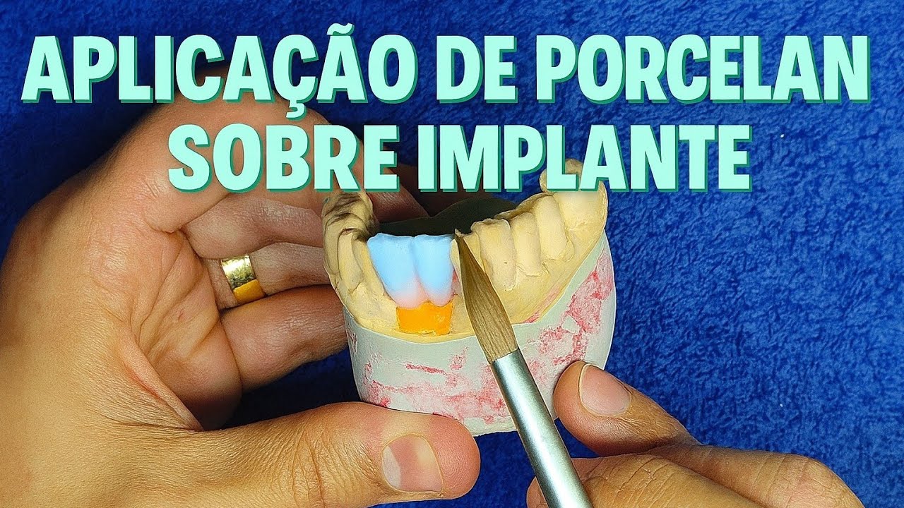 Aplica&ccedil;&atilde;o de porcelana sobre implantes para INICIANTES!