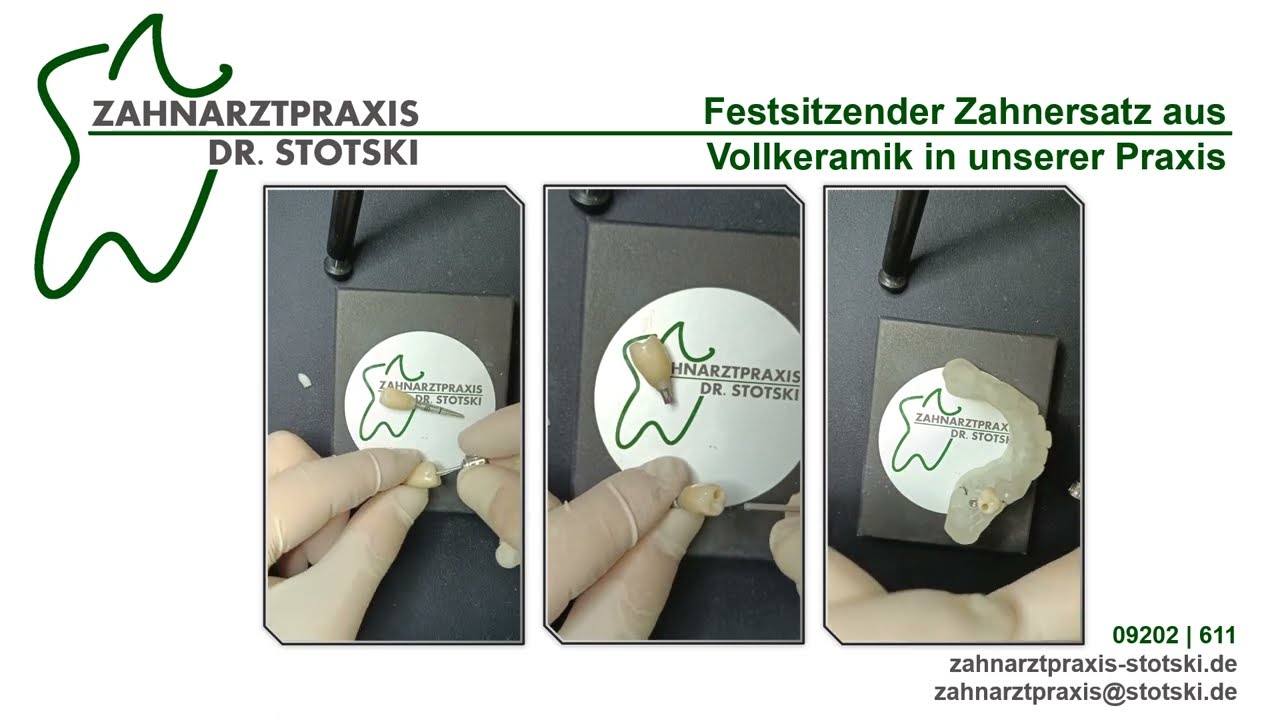 Festsitzender Zahnersatz aus Vollkeramik auf Implantaten