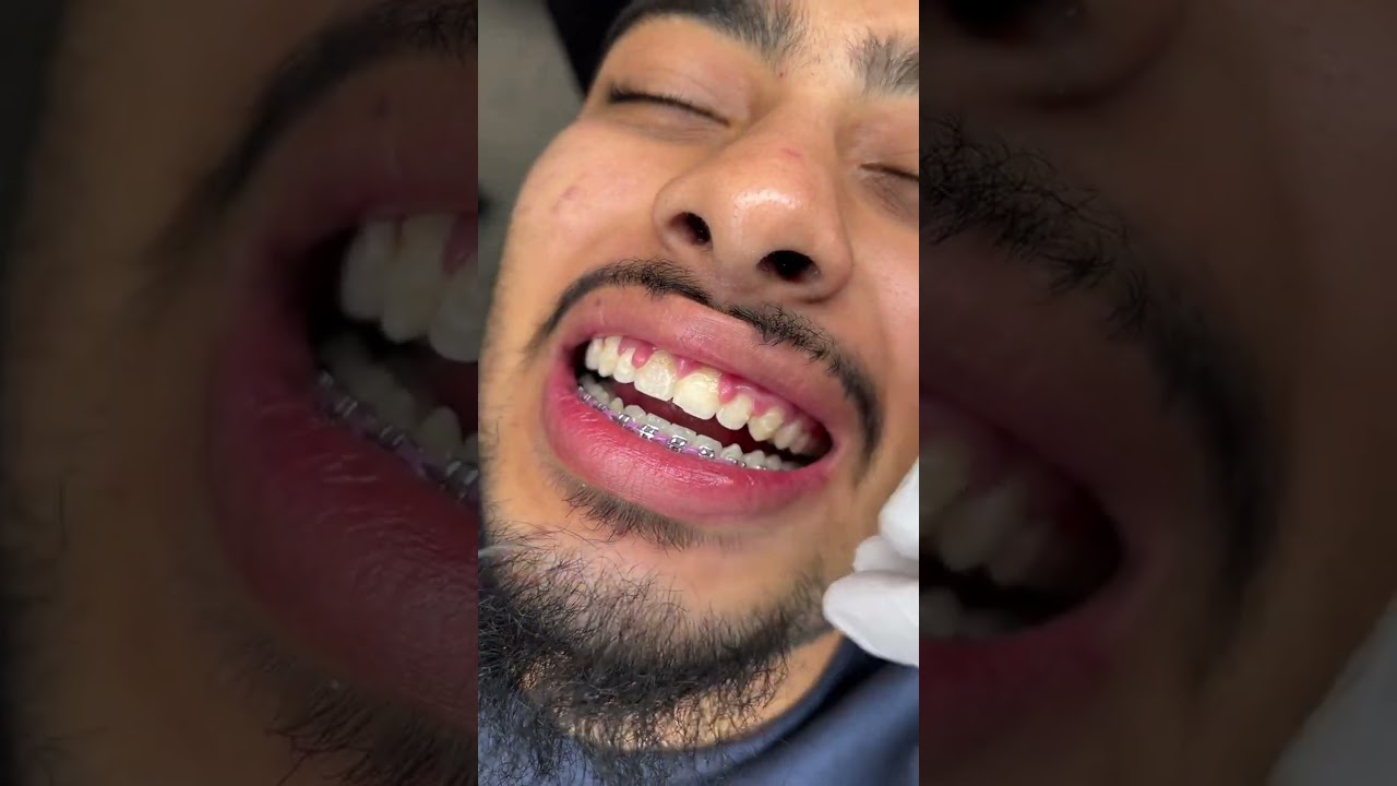 Braces Off Before Christmas!