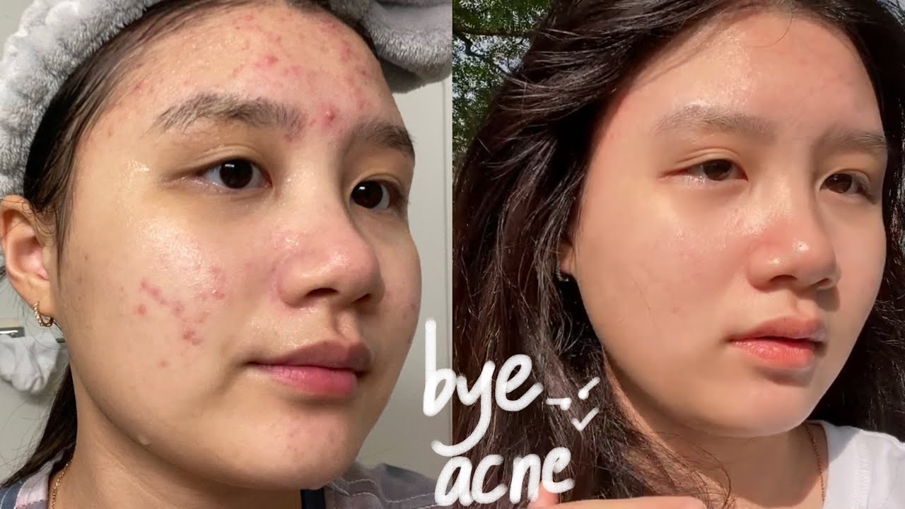3 TUẦN TRỊ MỤN DỨT ĐIỂM | THÀNH CÔNG RỒI 😭 | Cloudoris