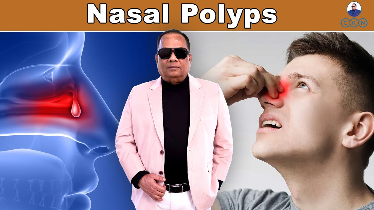 NASAL POLYPS / CKN