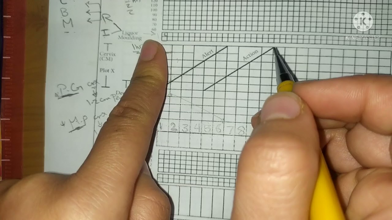 How to use Partograph