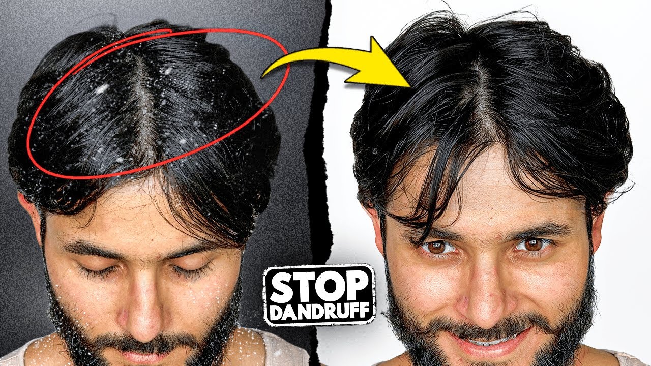 How to Cure Dandruff (From Root Level)