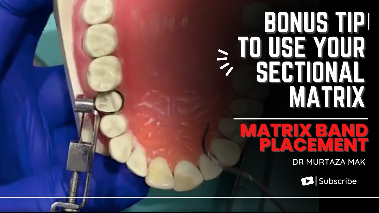Matrix band placement- Bonus tip to use your sectional matrix