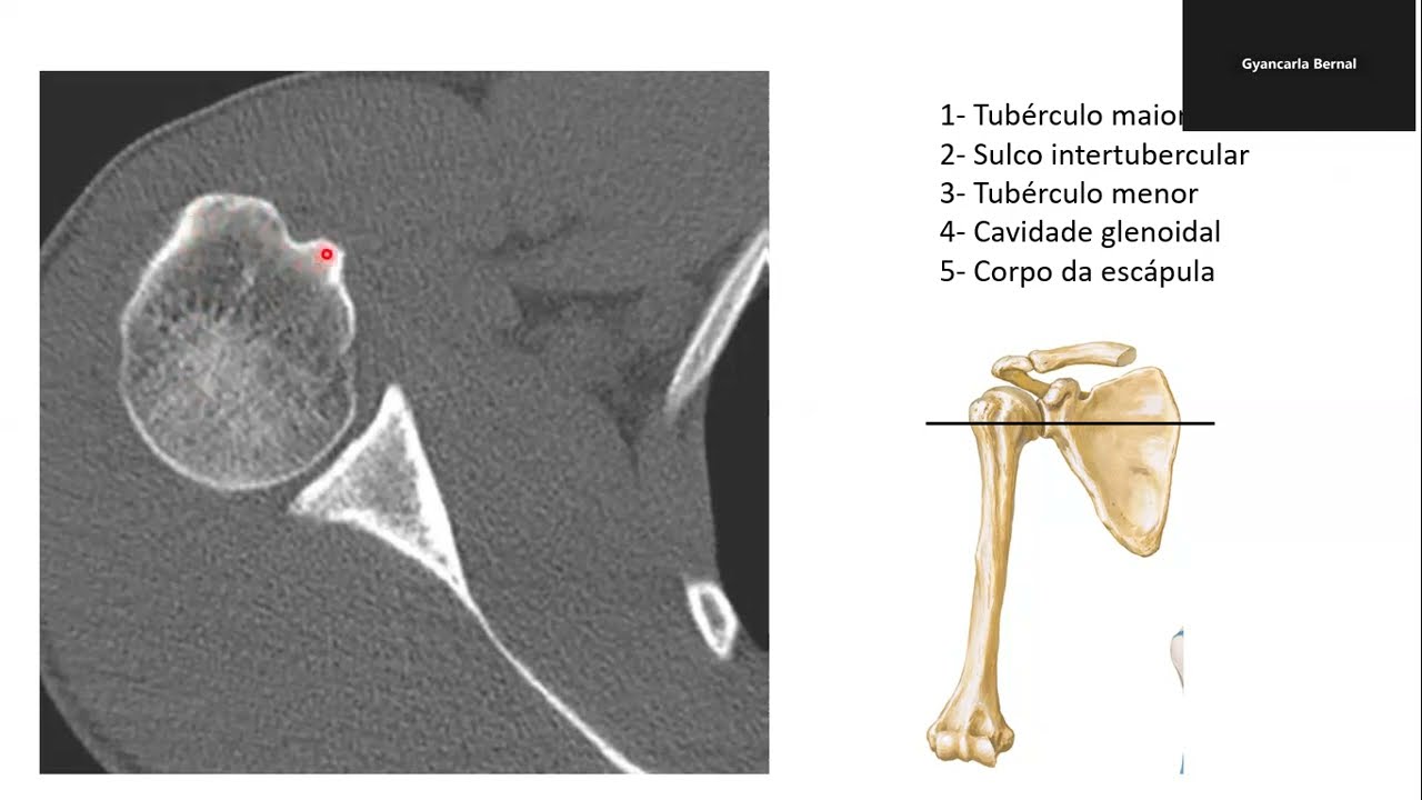 Anatomia do ombro por imagens de tomografia computadorizada