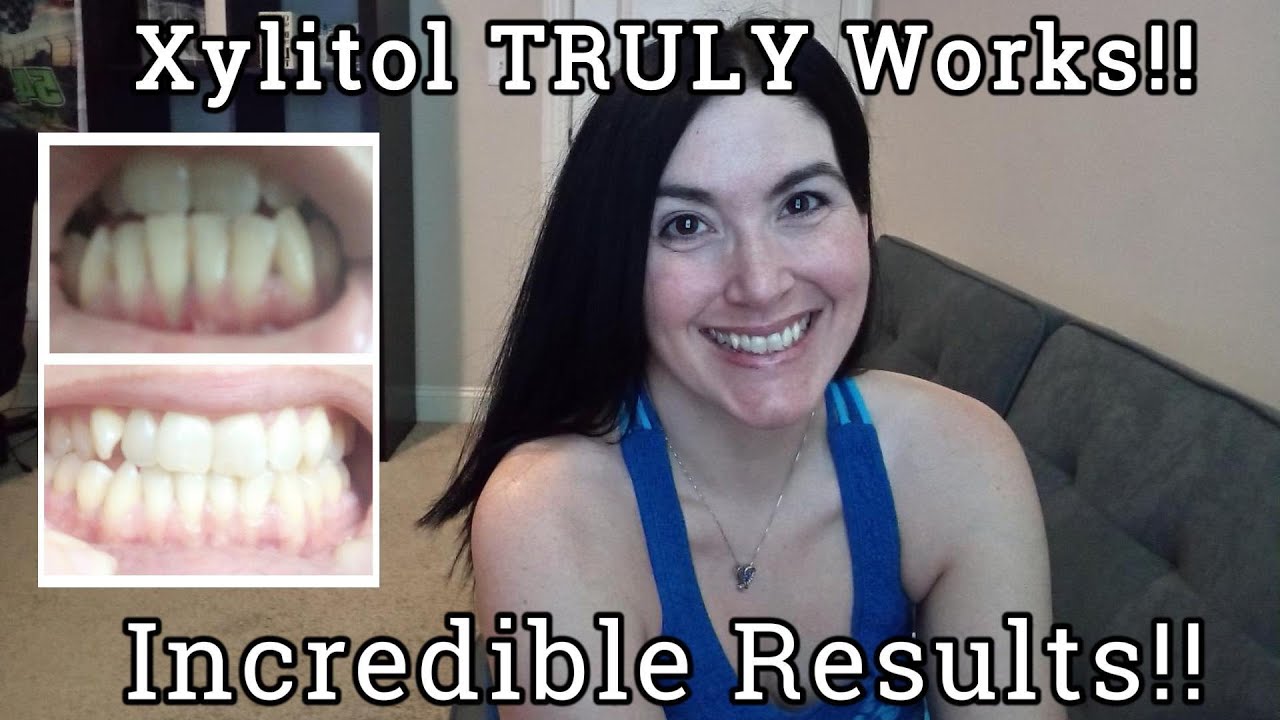 My 12 Month Xylitol Results: Gum Recession Reversed/ Teeth Remineralized!
