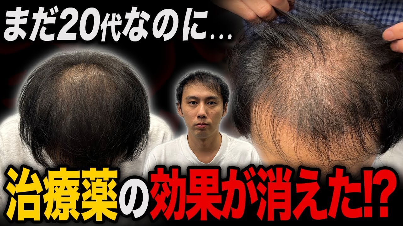 【20代薄毛】AGA治療をして10ヶ月経過した姿が衝撃すぎた...。