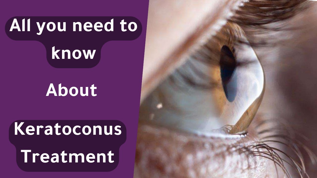 Essential Keratoconus Treatment Options Every Patient Needs to Know | علاج القرنية المخروطية