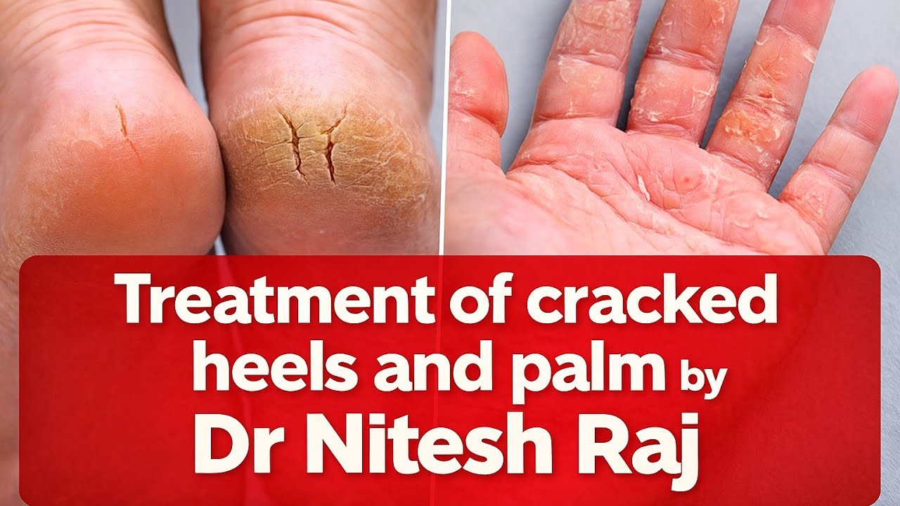 Cracked heels palms dry skin ka ilaz in hindi by#drniteshraj Best moisturizer in india