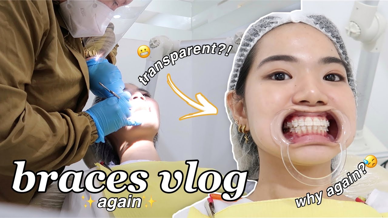 BRACES AGAIN.. *for the third time* 😩 trying out CERAMICS!
