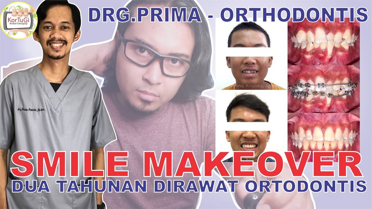 Pakai Behel Ortodontis: Dua Tahunan, Gigi Berjejal JADI RAPI BANGET!!! | KorTuGi