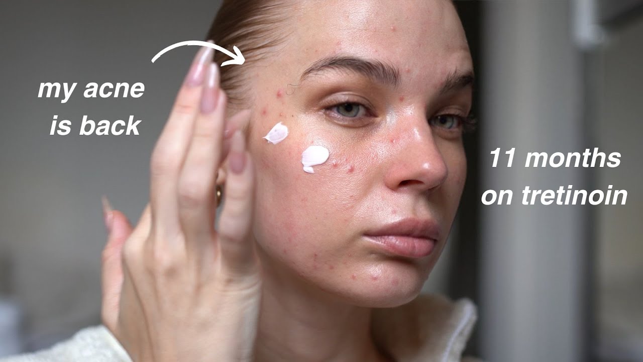 what did I do wrong? why is all my acne back after 11 months on tretinoin?