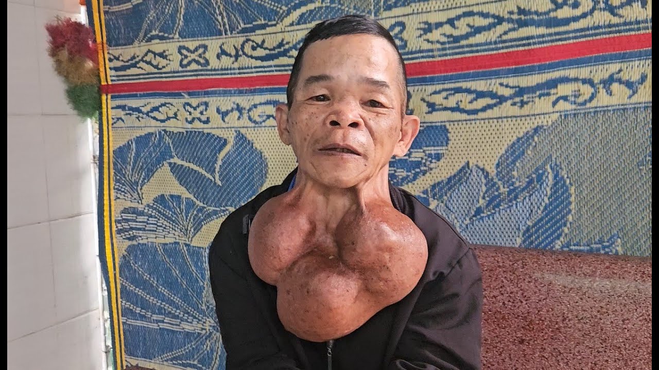Đã nhiều lần khuyên Chú bỏ đi khối U này, lần này không được chắc con hết duyên với Chú.