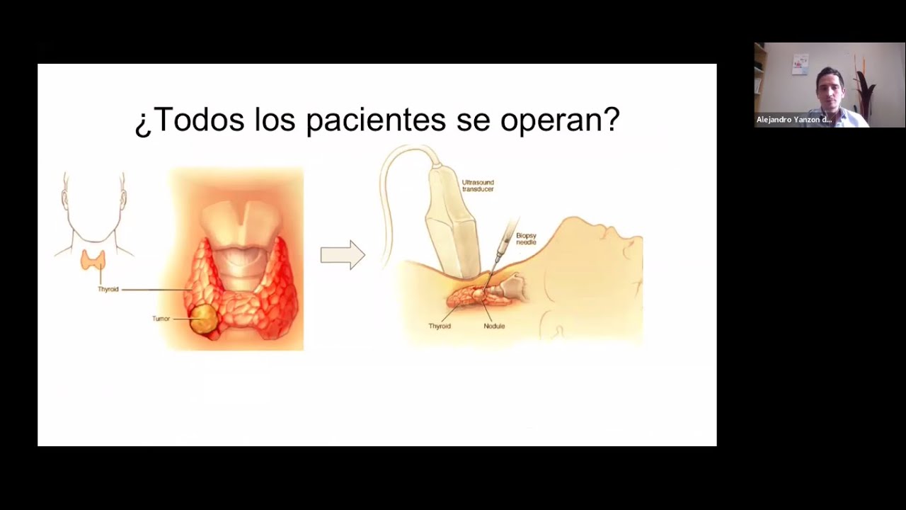 ¿Cómo es la Cirugía del Cáncer de Tiroides? - Dr. Alejandro Yanzón