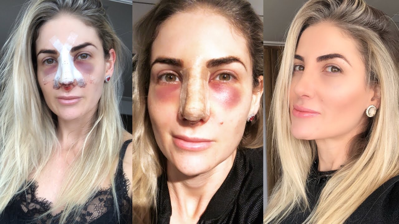 Minha rinoplastia