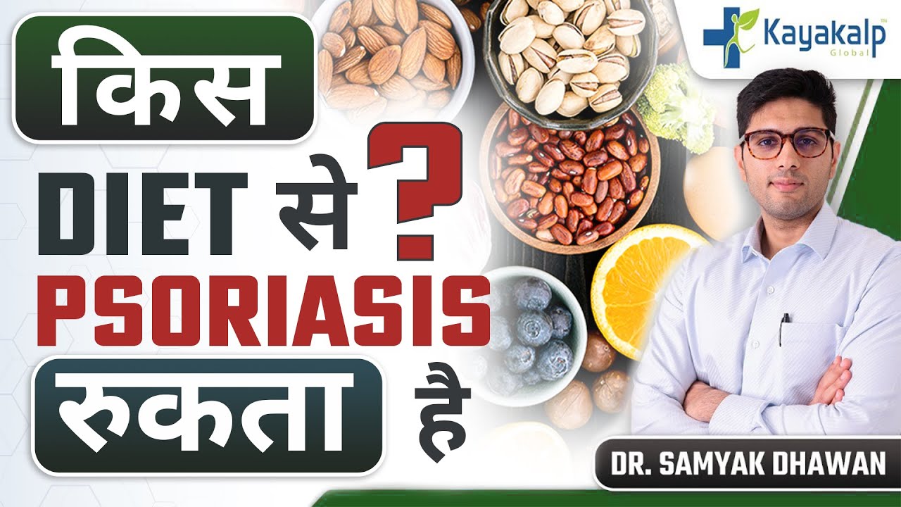 सोरायसिस को रोकने के लिए क्या खाएं क्या न खाएं? Control Psoriasis Flare Up with Diet and Nutrition