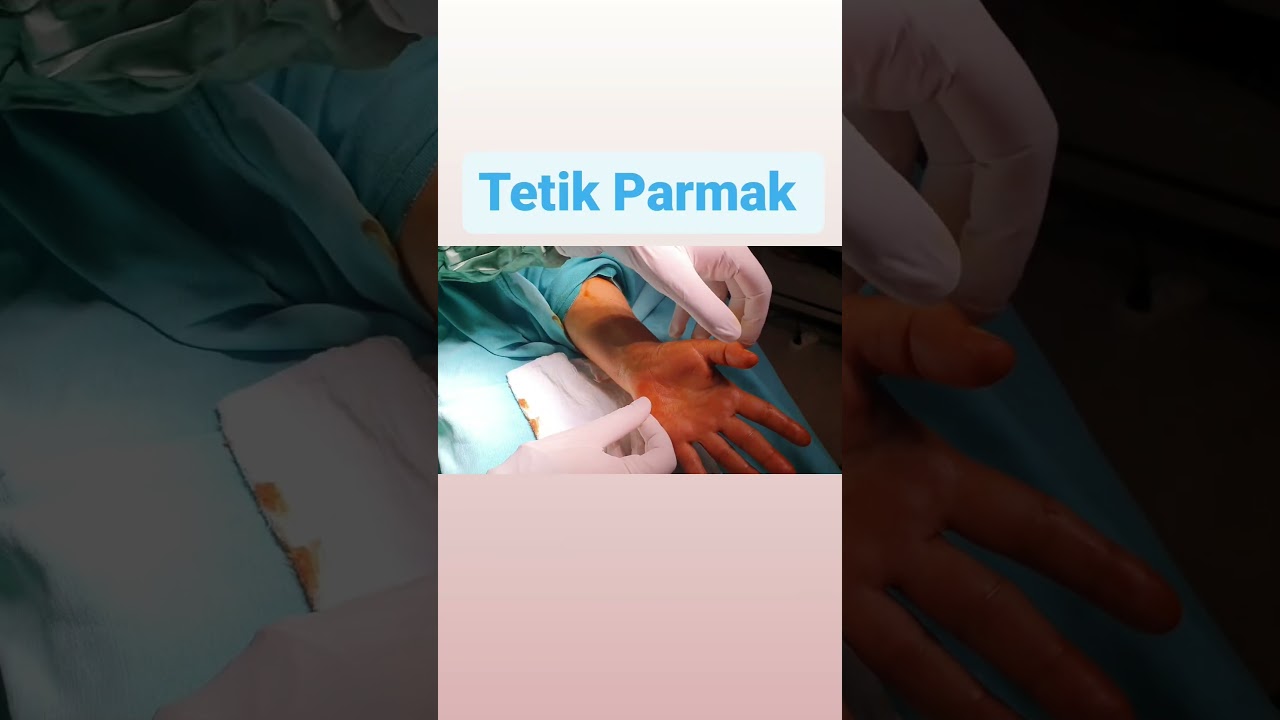 Tetik Parmak: Belirtileri, Nedenleri ve Tedavi Y&ouml;ntemleri Bursa Medical Park Hastanesi