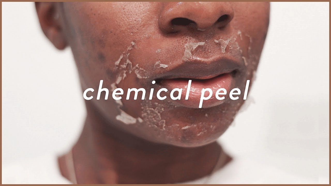 I Tried The STRONGEST VI Peel 😰 | Chemical Peel Before and After For Acne & Acne Scars