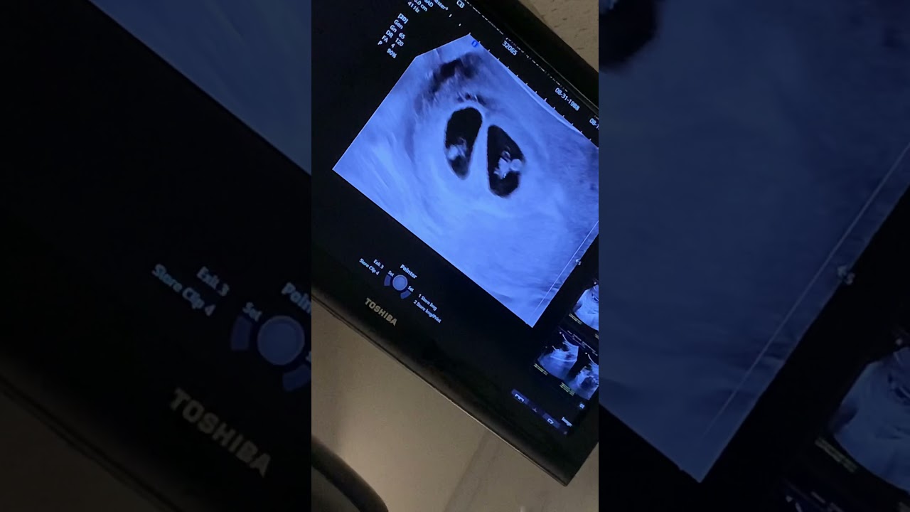 Finding out I&rsquo;m pregnant with triplets 2021 ultrasound.. *Triplets*