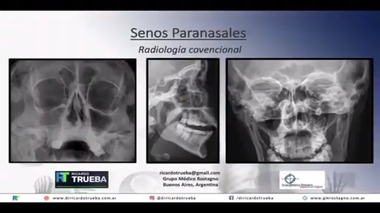 RADIOLOGIA DE LOS SENOS PARANASALES