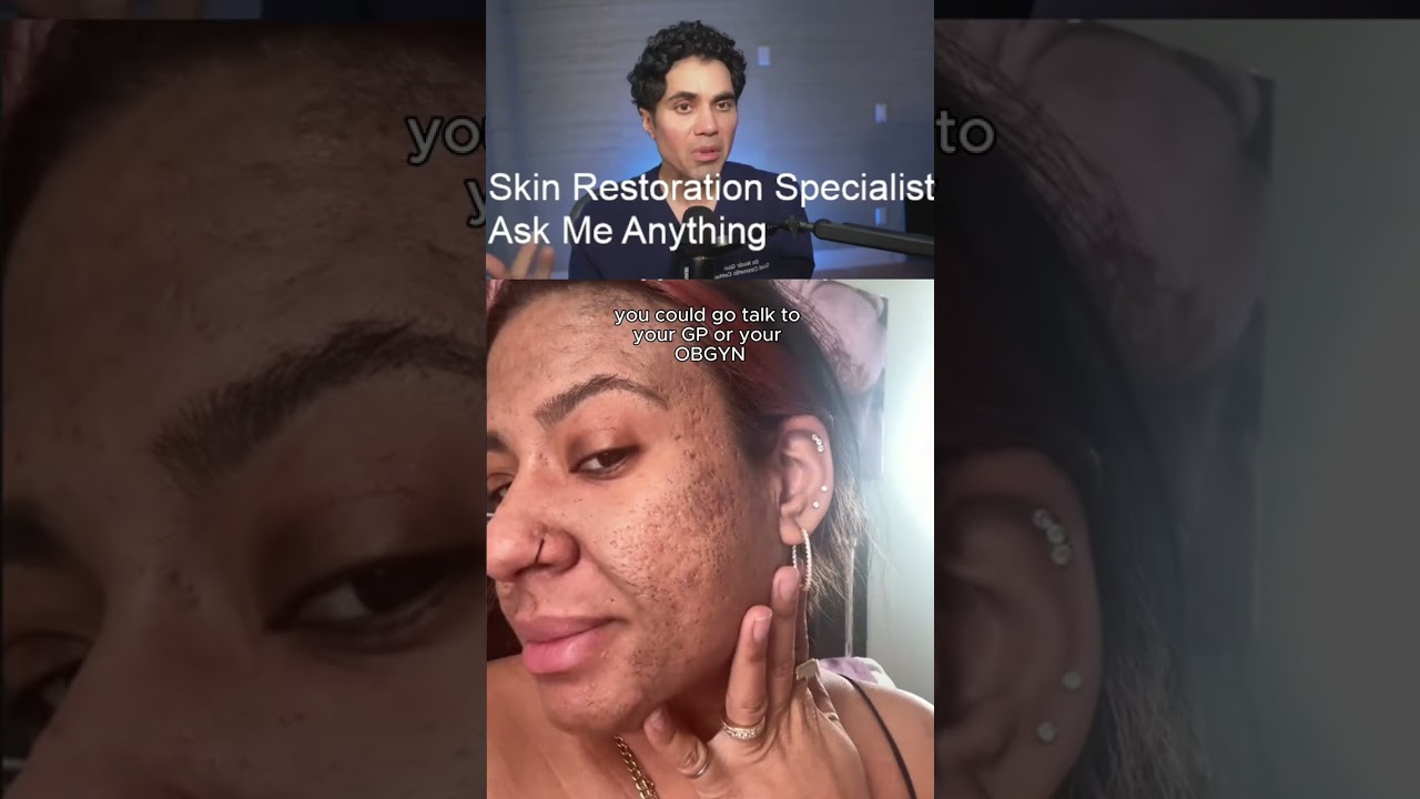 Dr. Qazi Reacts To Viral Acne Scar Video #AcneScars