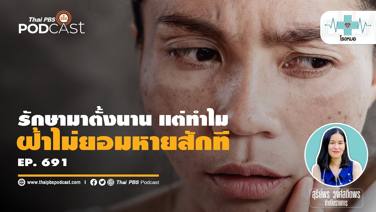 หน้าเป็นฝ้า ทำไมรักษาไม่หายสักที | โรงหมอ