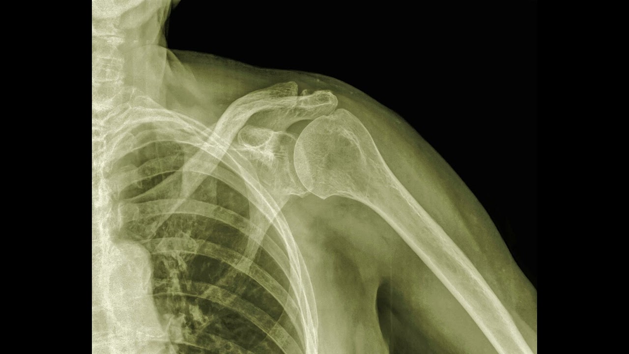AC Joint Arthritis Treatment