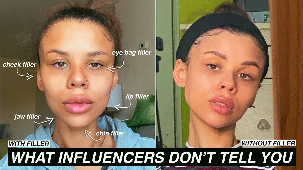 Why I STOPPED getting FILLER and YOU maybe should too