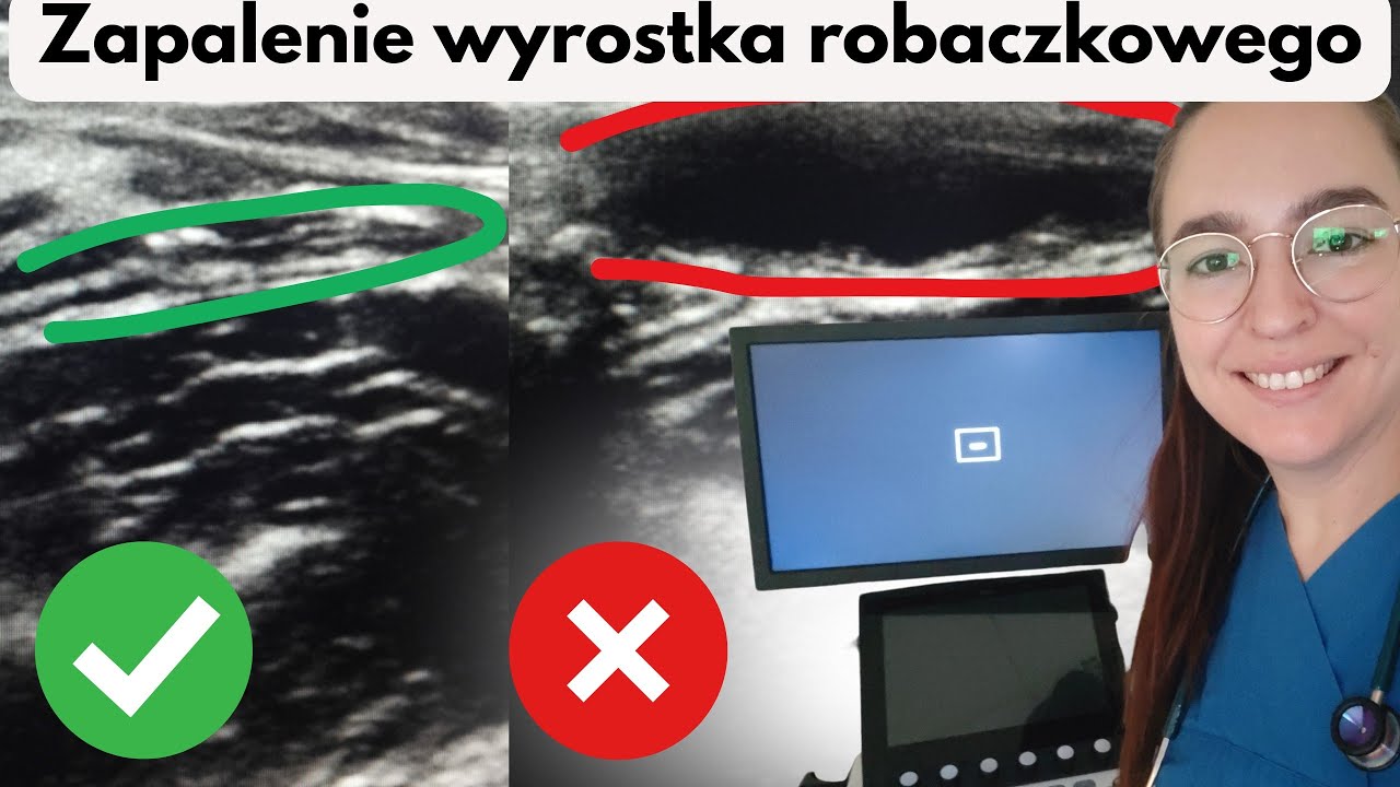 Zapalenie wyrostka u dzieci – objawy, jak rozpoznać, kiedy do lekarza? | Pediatra wyjaśnia