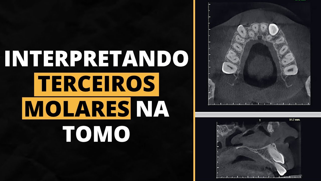 INTERPRETANDO TERCEIROS MOLARES NA TOMO
