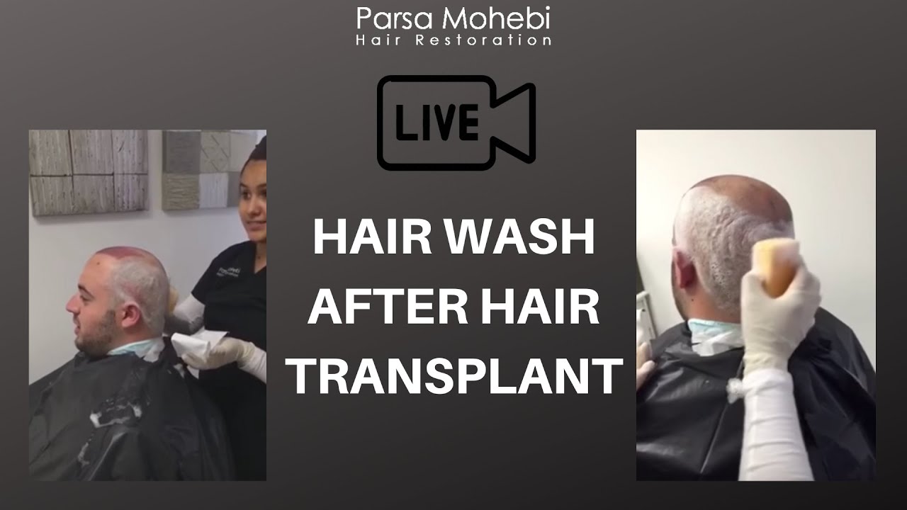 Hair Wash After Hair Transplant