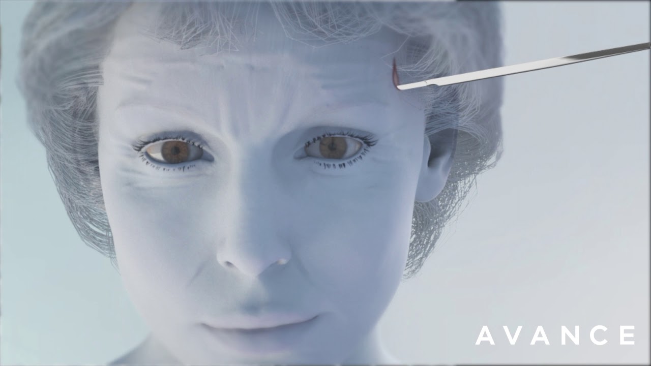 Dr. Erez Dayan Browlift Animation Avance Plastic Surgery Institute