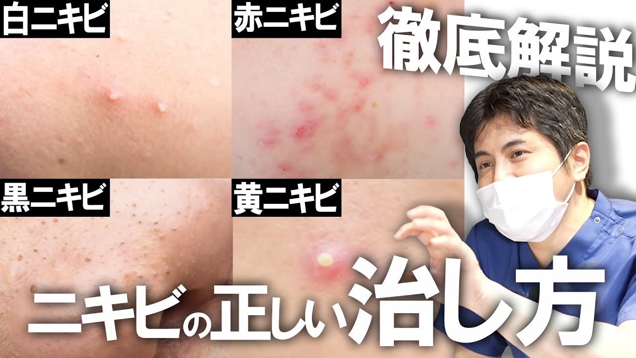 【現役ニキビの治し方】症状ごとに治療方法は違う？！正しいニキビの治し方を現役医師が解説します