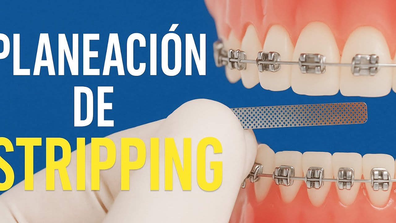 Planeación de Stripping