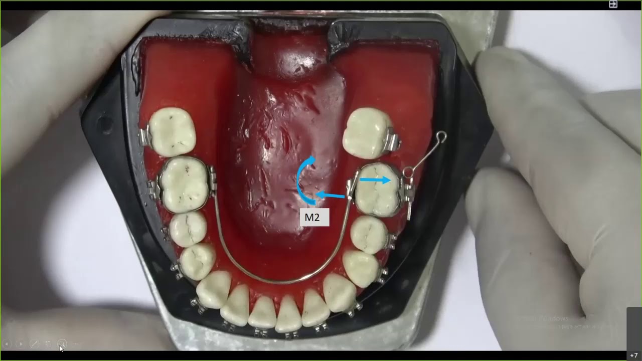 Biomecánica Ortodoncia - 2das molares inferiore y superiores