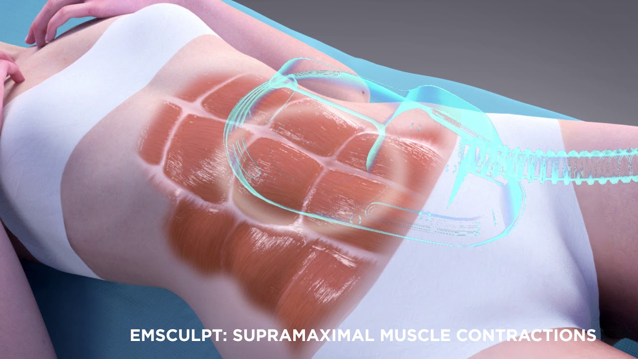 How it works: EMSculpt | The Cosmetic Skin Clinic