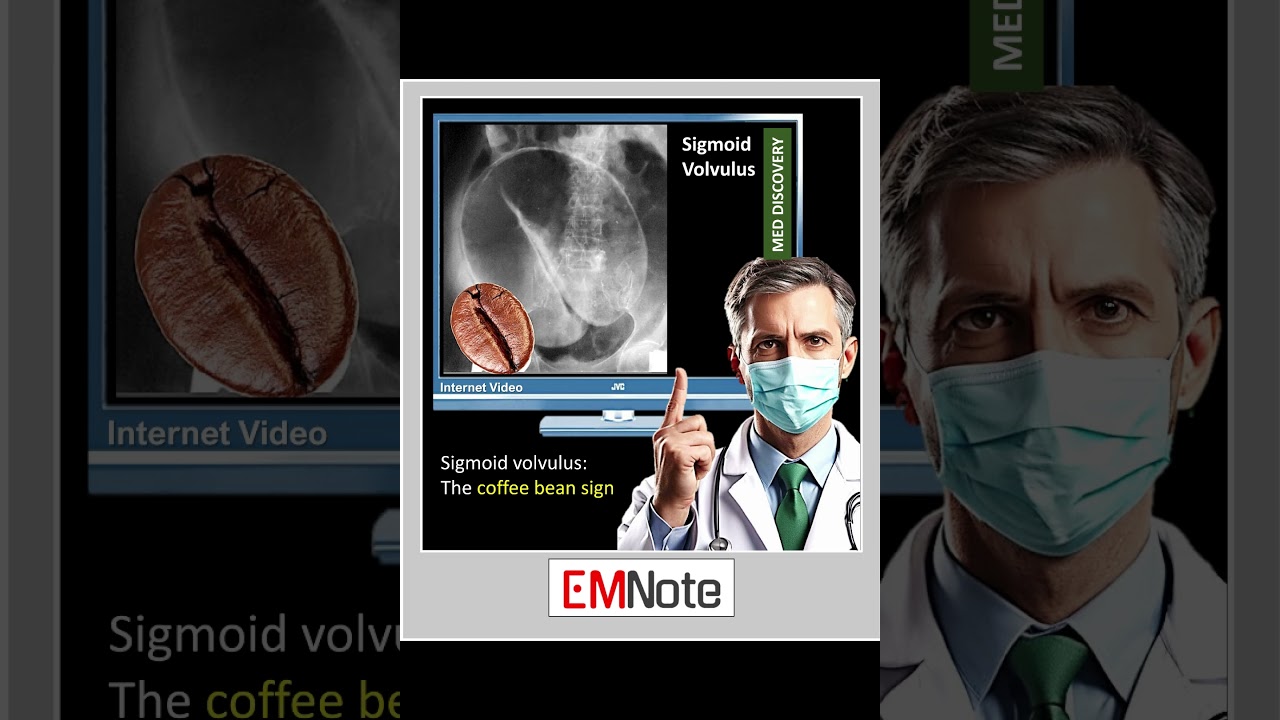 Sigmoid volvulus coffee bean sign