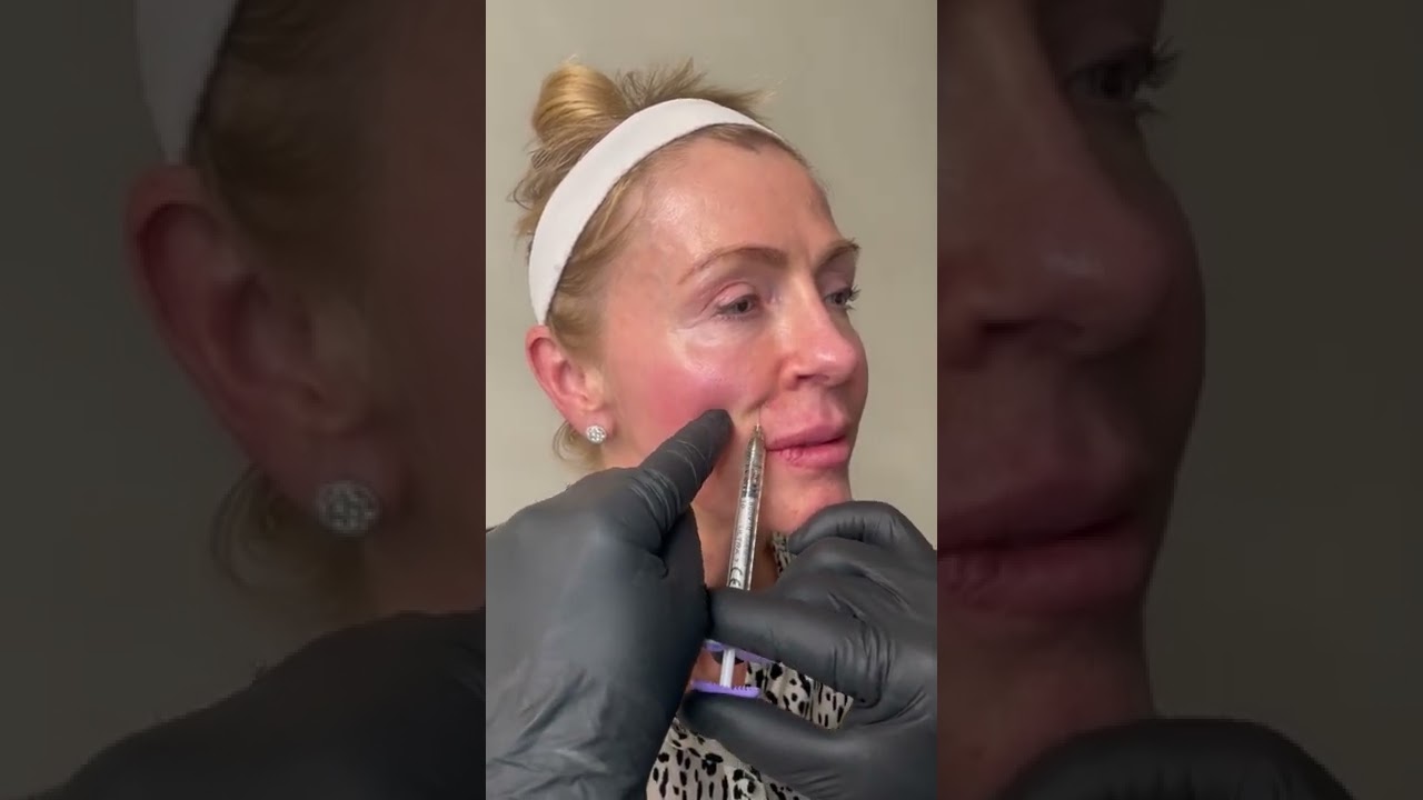 NASOLABIAL FOLD TEACHING VIDEO