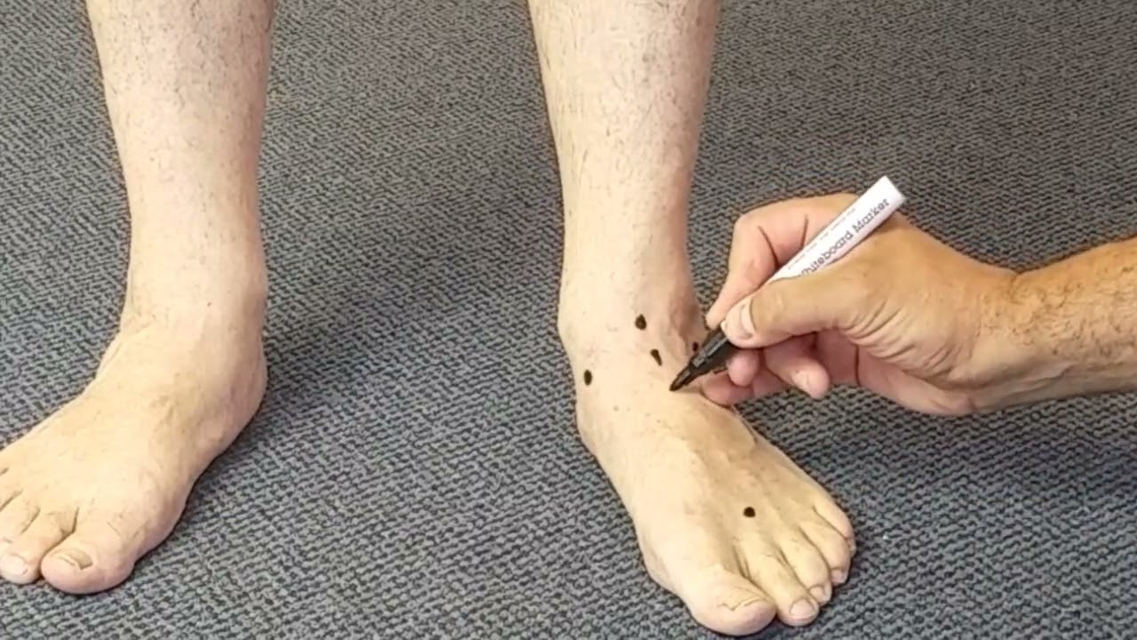 Correct Position for heat moulding ICB orthotics