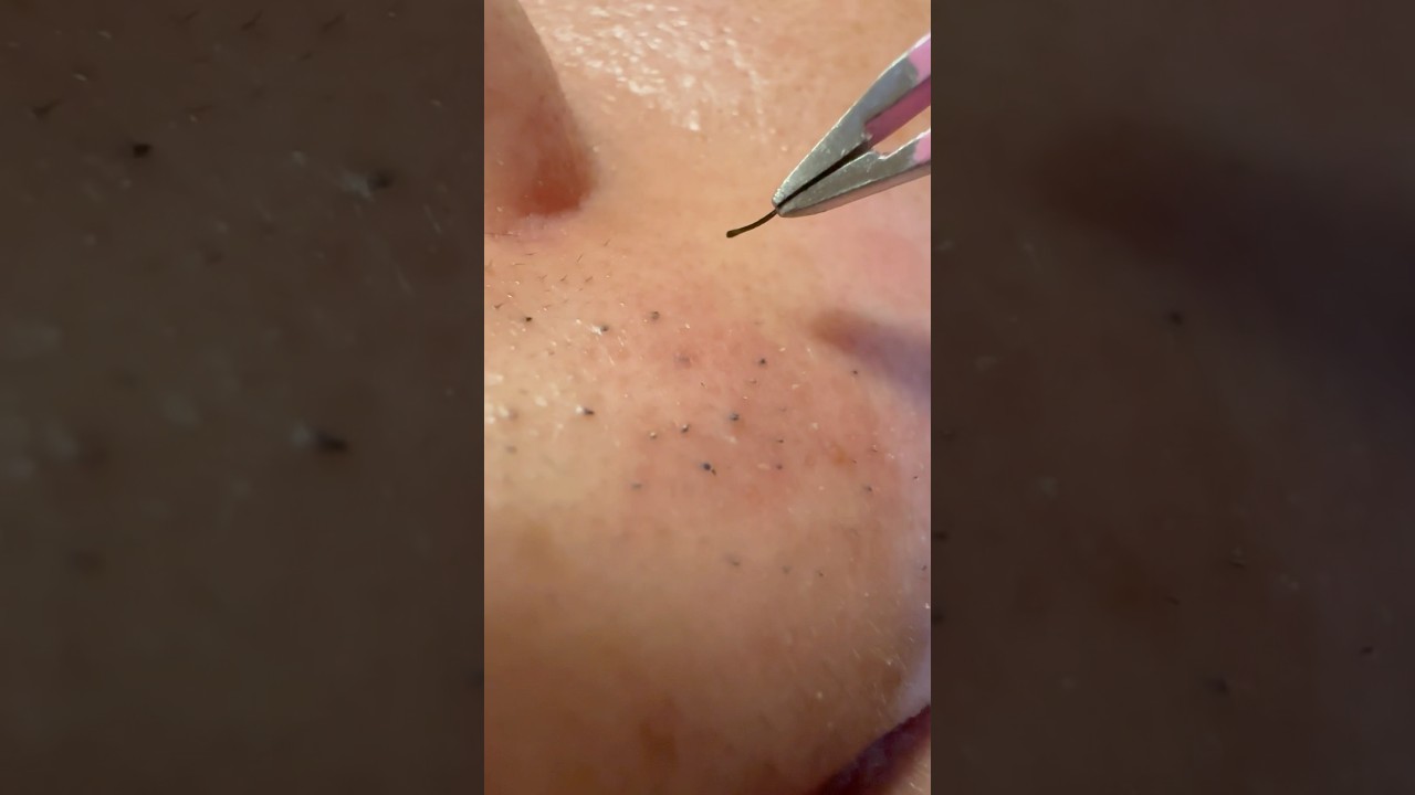 Oh My! Didn&rsquo;t Expect That Thick Beard Hair to Pop Out! #tweezers #plucking #hairremoval #satisfying