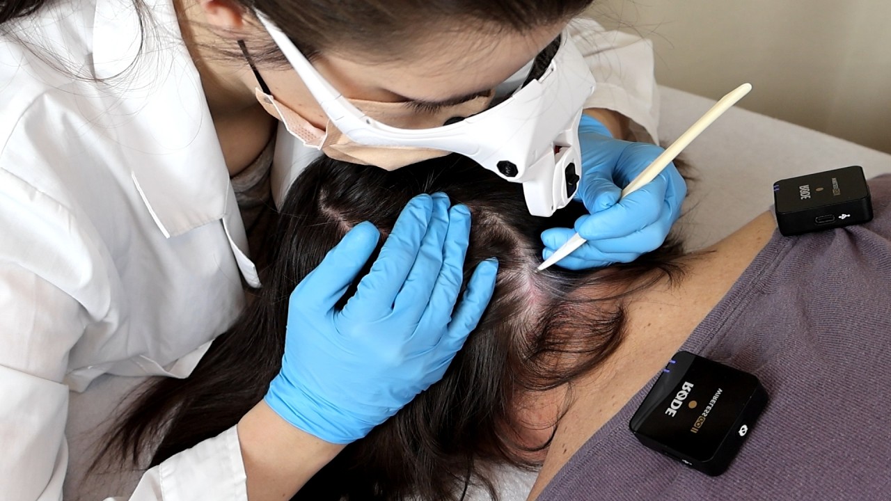 ASMR Longest SCALP Exam and TREATMENT : Sensory Tests, Skin Check, Lice Removal & Hair Parting