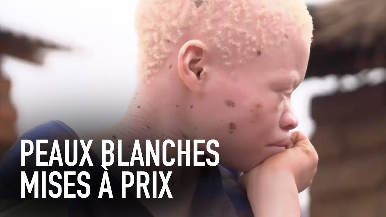 TRAFIC D'ALBINOS (Malawi) - L'Effet Papillon