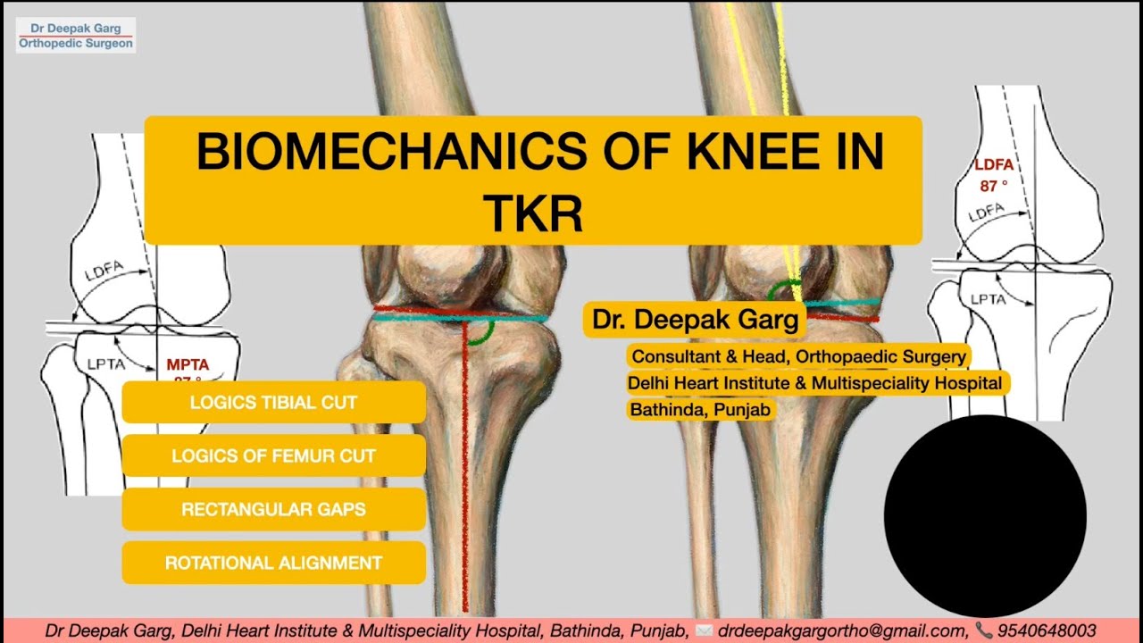STEP BY STEP BIOMECHANICS IN TOTAL KNEE ARTHROPLASTY