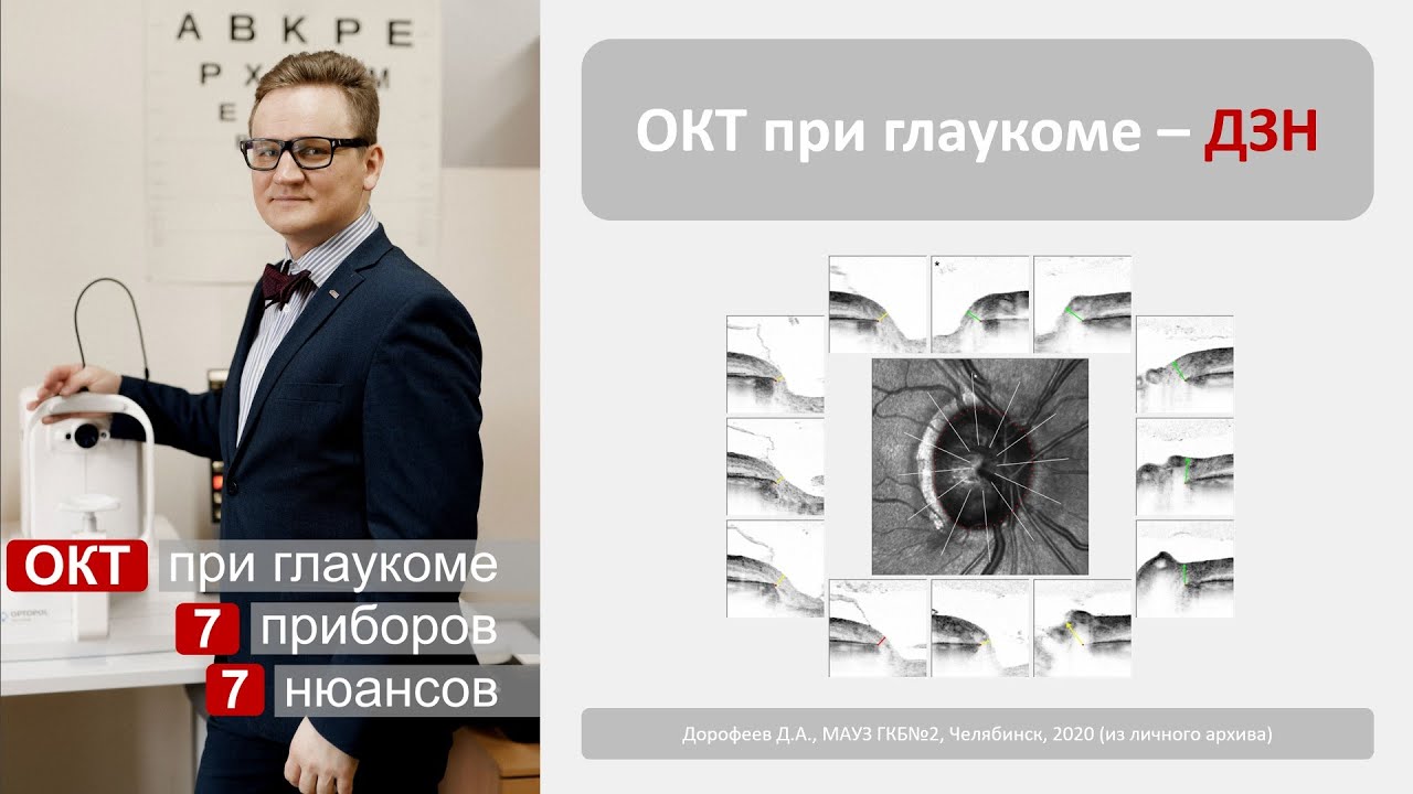 ОКТ при глаукоме. ДЗН